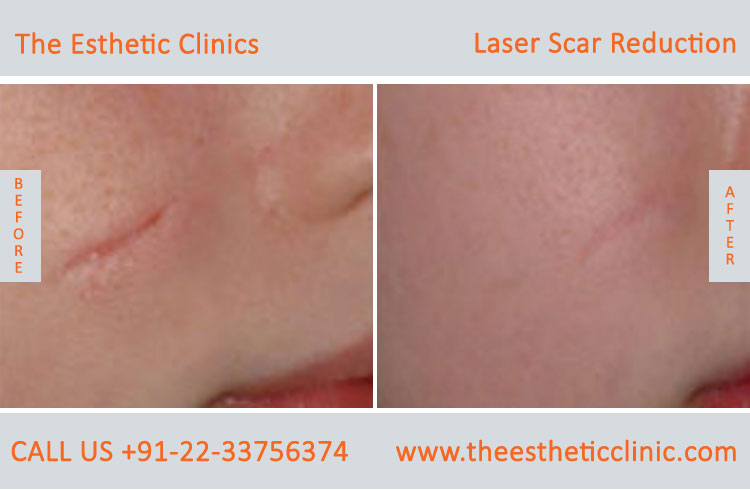 Laser scar reduction removal Treatment before after photos in mumbai india (6)